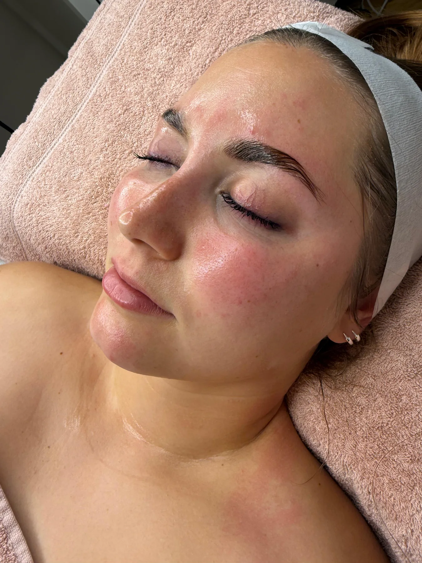 Gesicht derselben Kundin direkt nach der HydraFacial-Behandlung