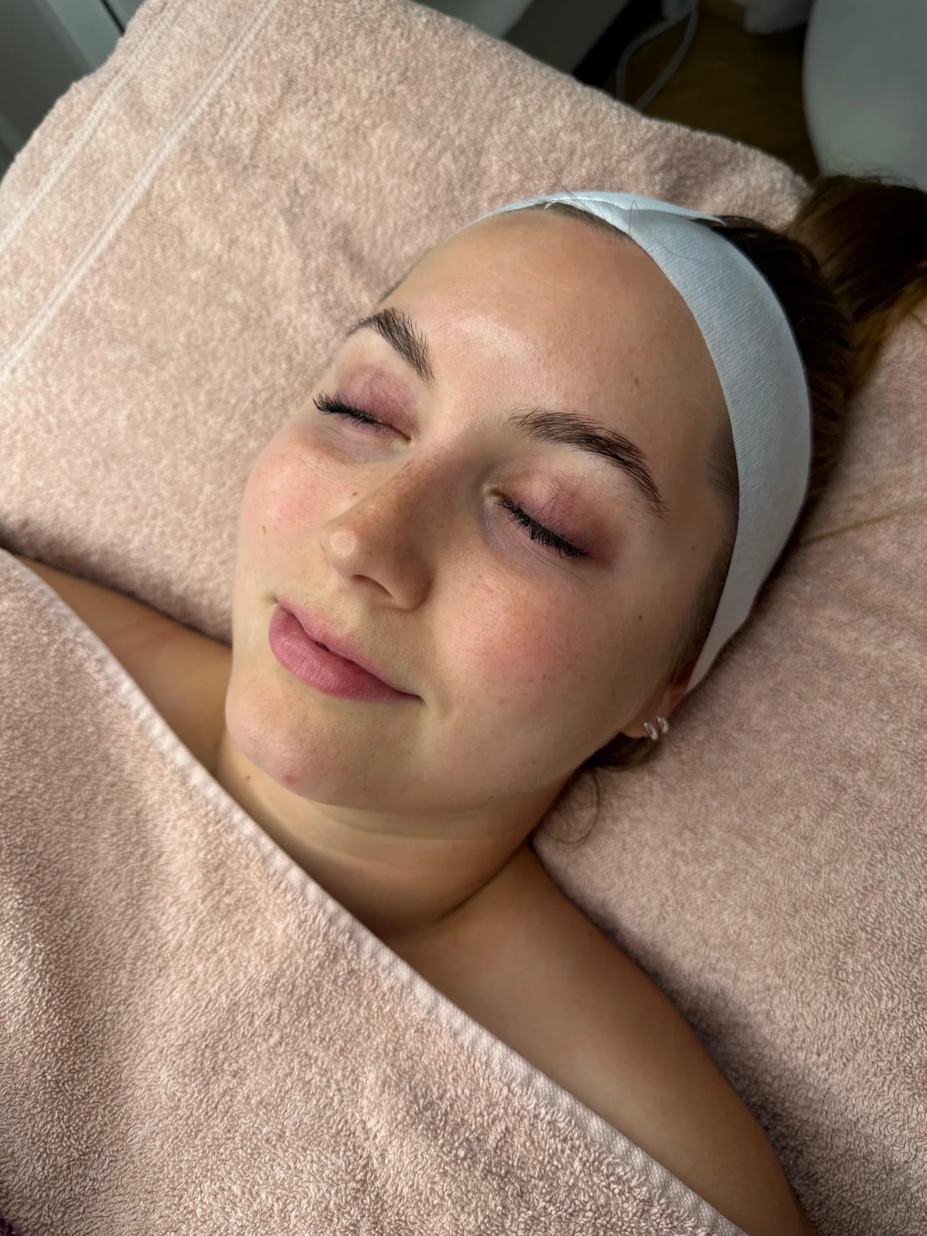 Gesicht einer Kundin vor der HydraFacial-Behandlung