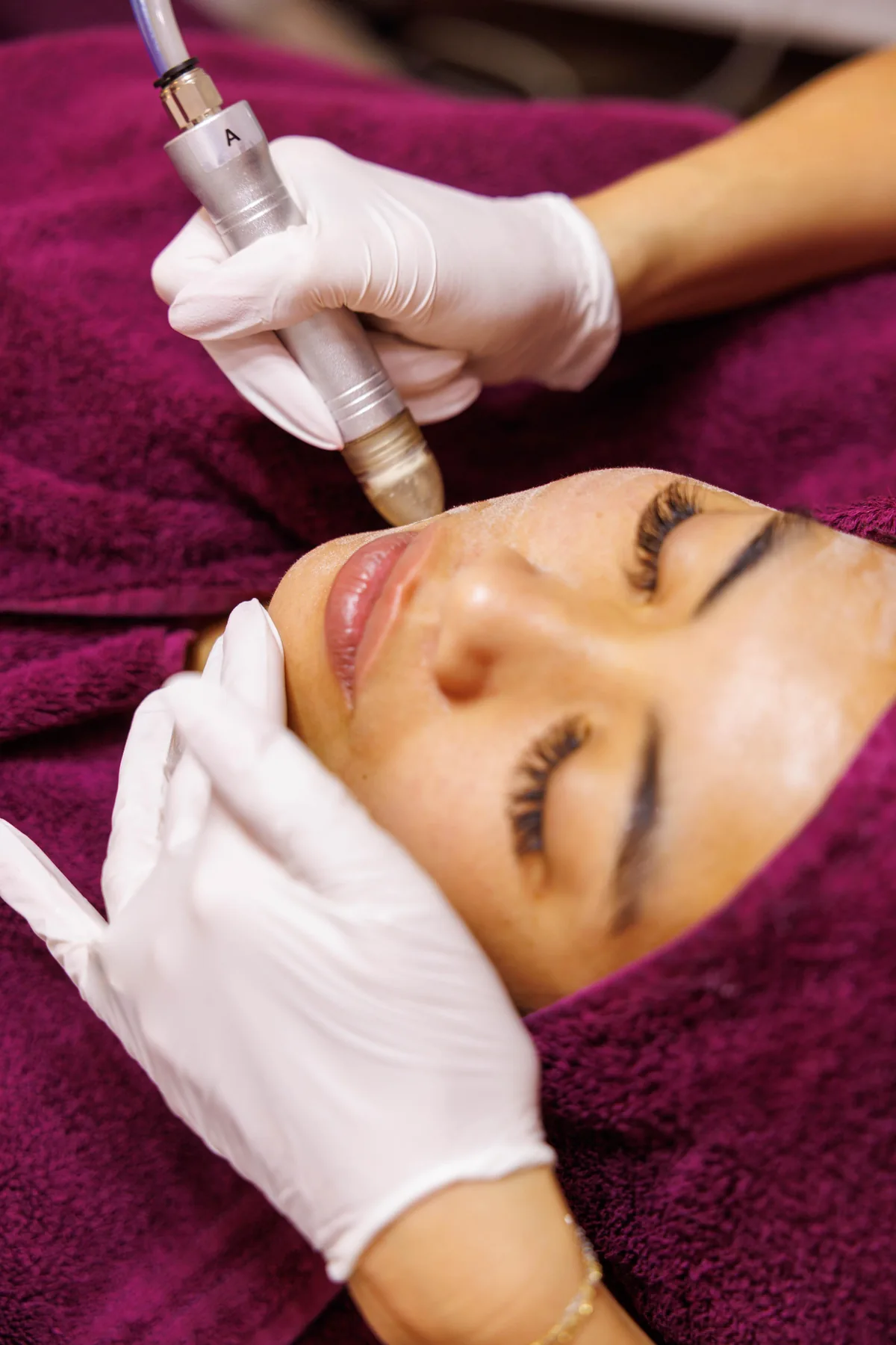 HydraFacial-Aufsatz während der Behandlung am Kinn