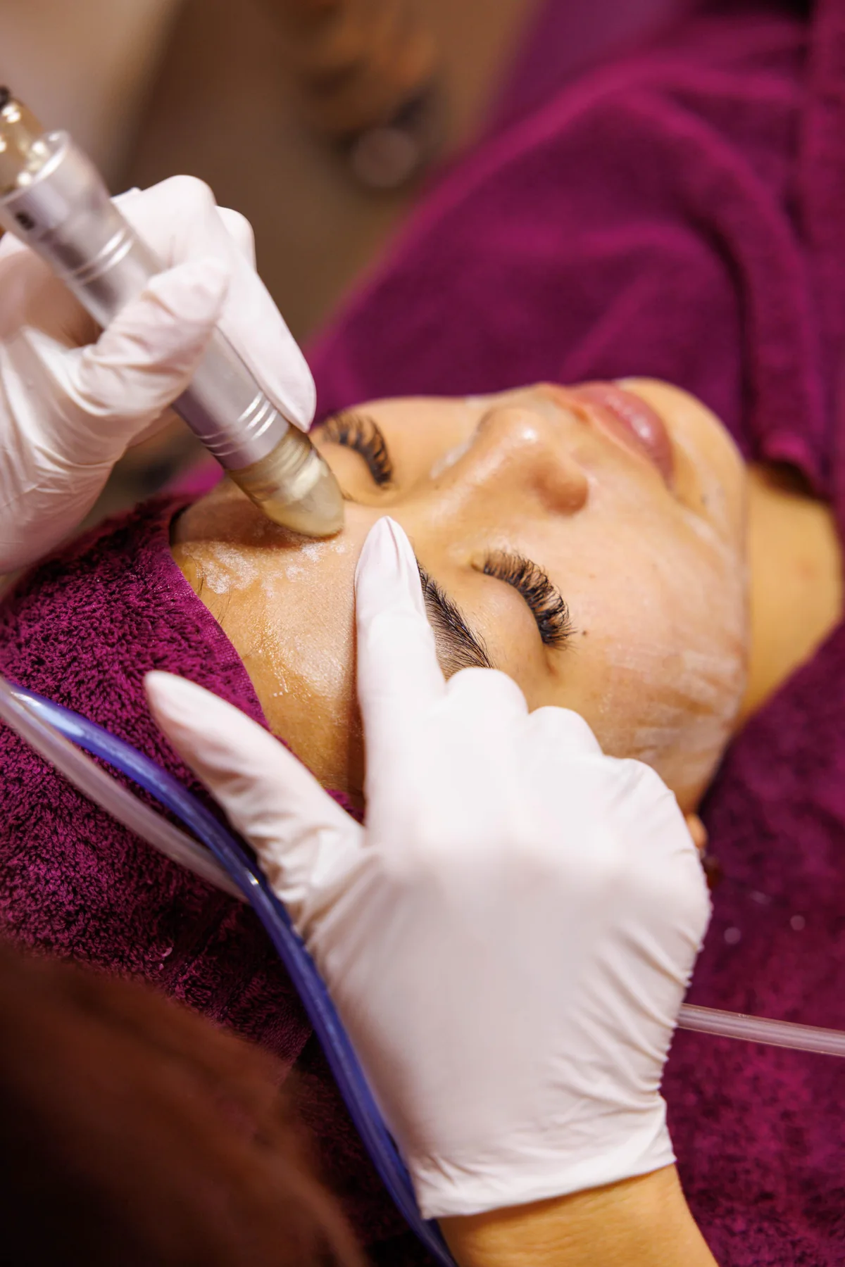 HydraFacial-Aufsatz während der Behandlung an der Stirn