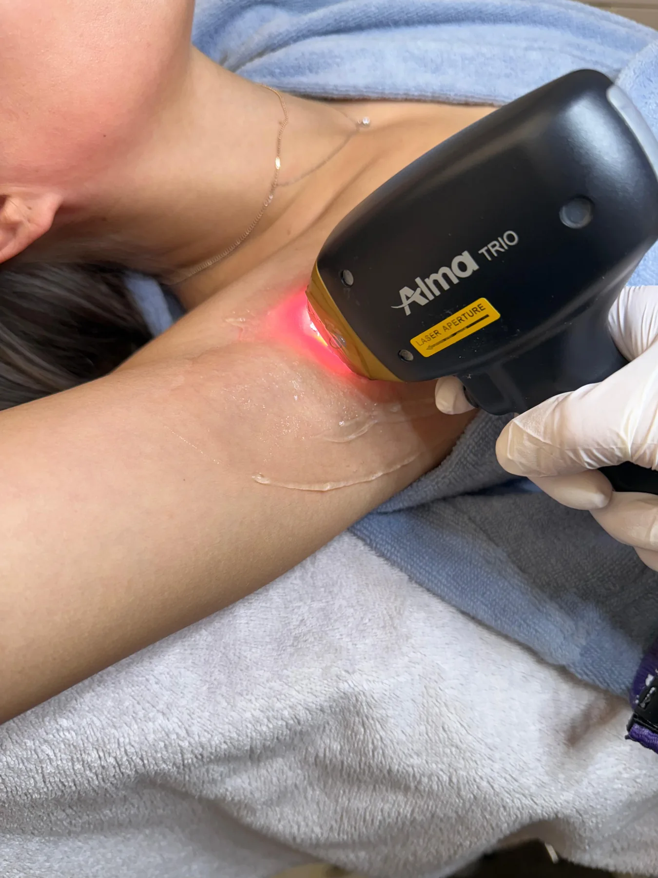 Laser Hair Removal an der Achsel bei La Princessa
