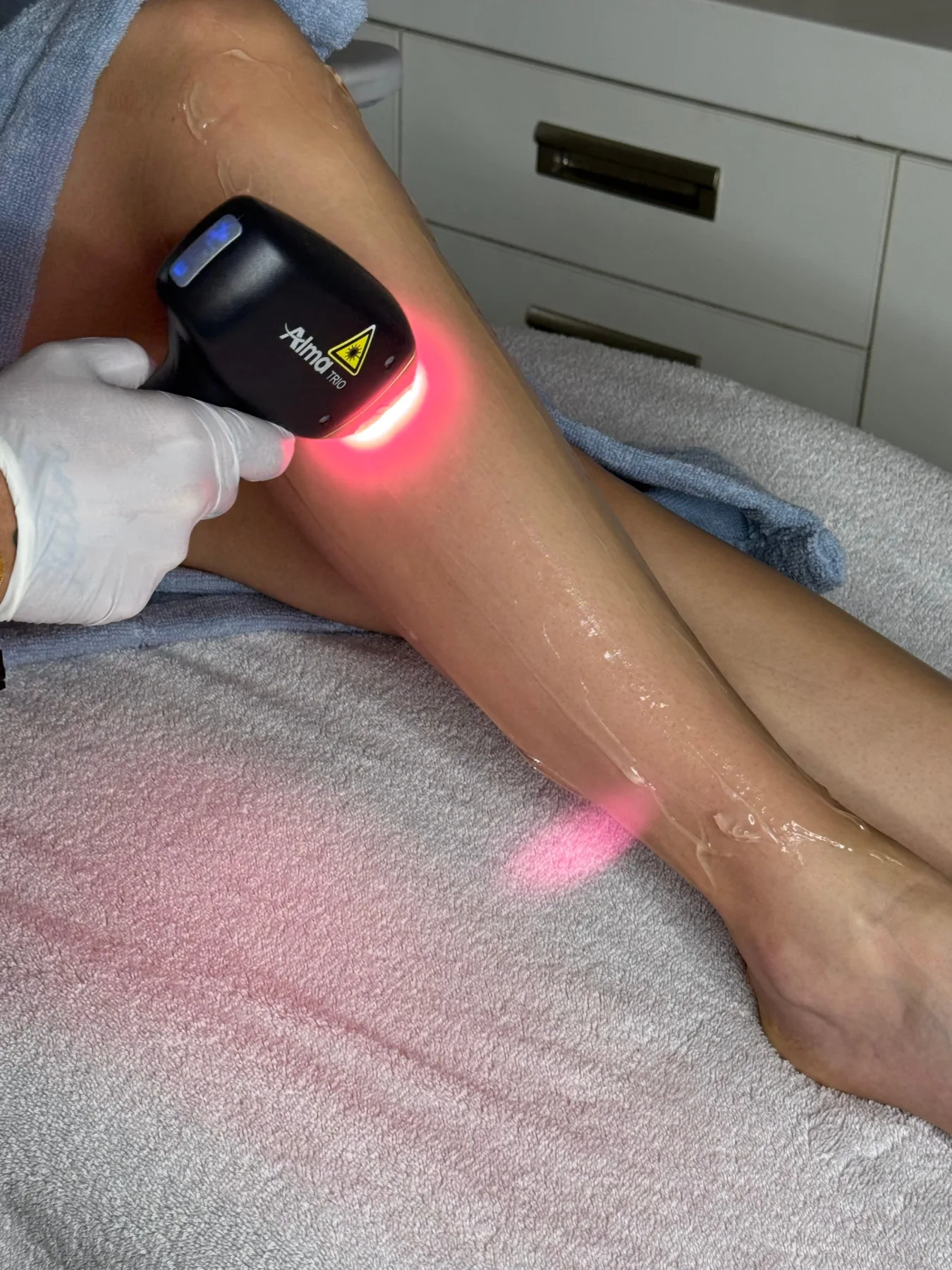 Laser Hair Removal am Bein mit Alma Gerät